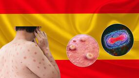 ¡Alerta sanitaria! Posible entrada a España de la nueva cepa mortal de mpox, así puedes identificar al virus