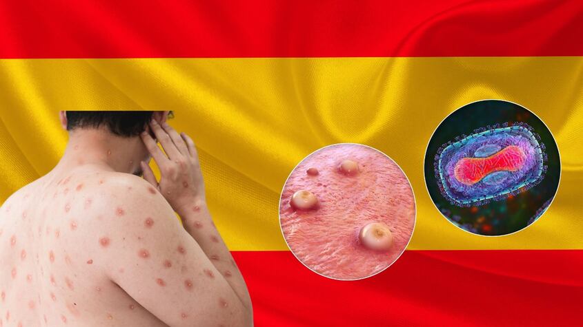 ¡Alerta sanitaria! Posible entrada a España de la nueva cepa mortal de mpox, así puedes identificar al virus