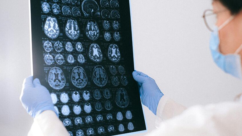 Fármaco contra el cáncer podría ser tratamiento para el Alzheimer; expertos investigan