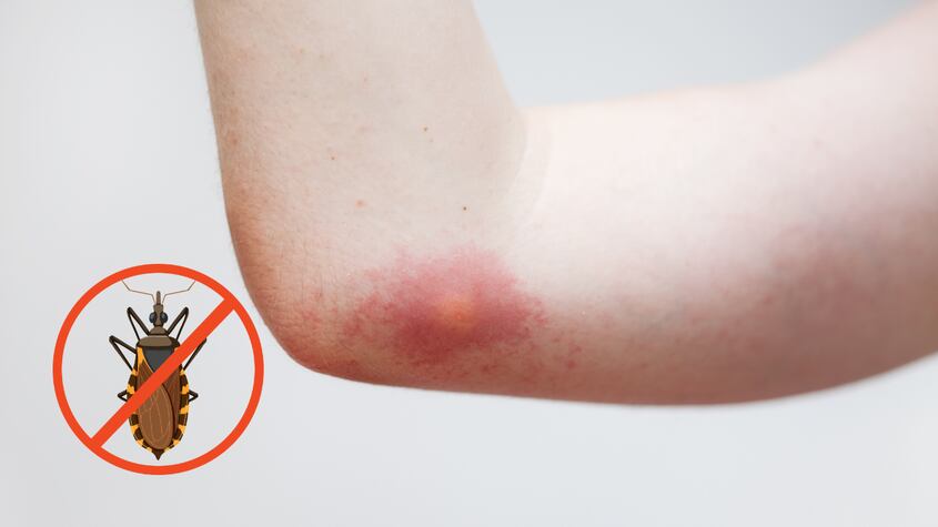 Día Mundial de la Enfermedad de Chagas: ¿Qué es y cómo se contagia?