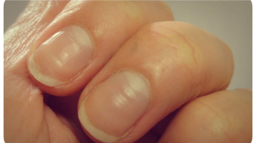 Líneas de beau: ¿qué significa si están en tus uñas?