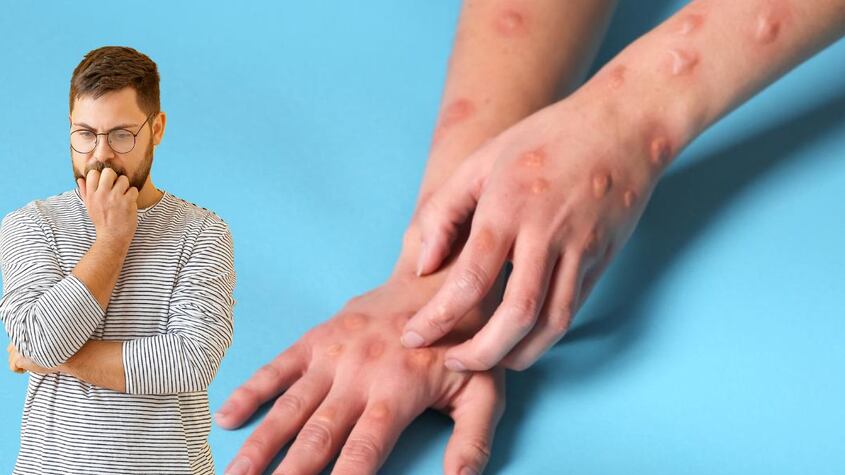 Mpox.
