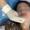 Una joven sufrió quemaduras por la explosión de un globo en su cumpleaños en Vietnam