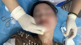 Una joven sufrió quemaduras por la explosión de un globo en su cumpleaños en Vietnam