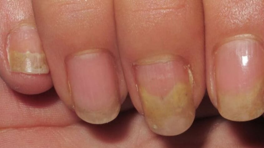 El significado de tener las uñas amarillas